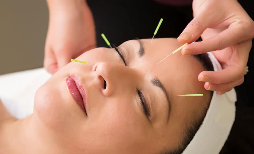 Facial Acupuncture